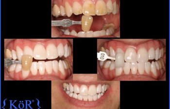 Patient Before & After KöR Whitening