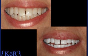 Patient Before & After KöR Whitening