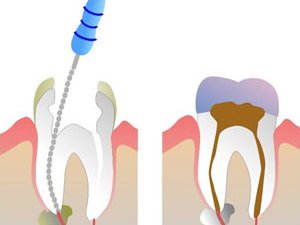 Alpharetta Root Canals