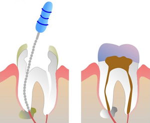 Alpharetta Root Canals