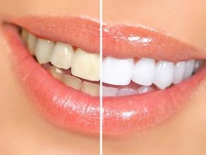 Whiter Teeth for a Stunning Smile