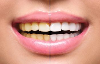 Teeth Whitening Before and After Alpharetta GA