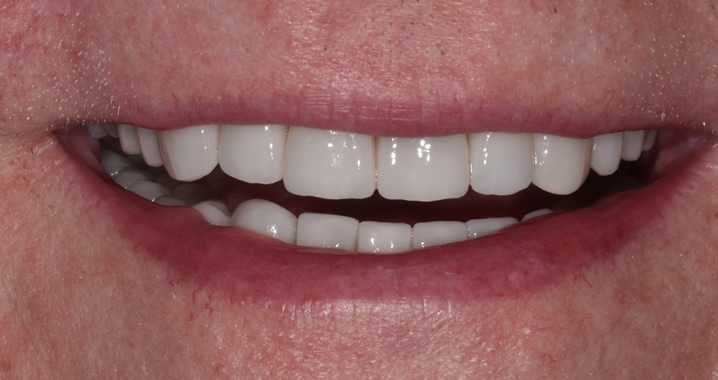 Equal white teeth after reconstruction