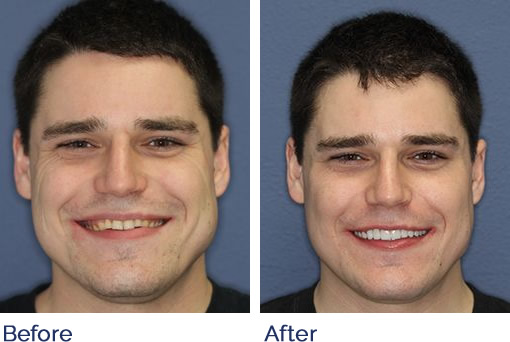 Two photos of a young man before and after repairing his teeth