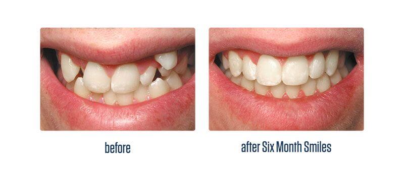 Crabapple Six month smiles patient - teeth before and after treatment