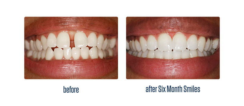 Crabapple Six month smiles patient - teeth before and after treatment