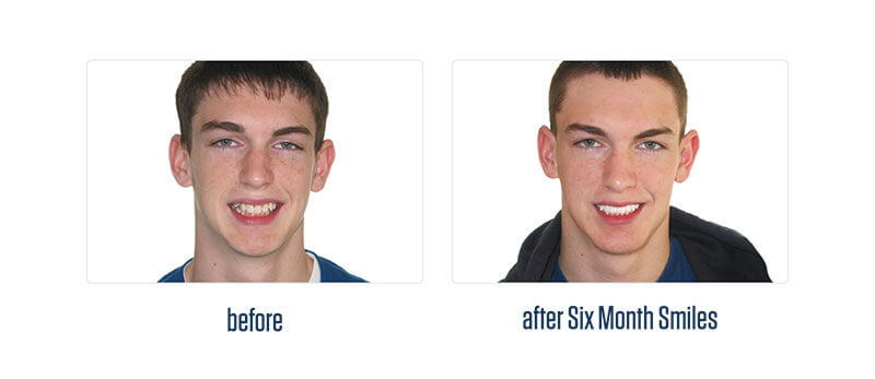 Crabapple Six Month Smiles teenage patient before and after treatment