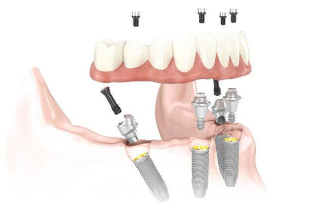 how All-on-4 dental implants work