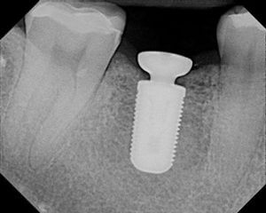 Actual Crabapple Patient Minimally Invasive Implant - Faster Healing