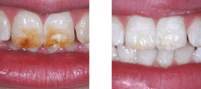 Crabapple Dental patient before and after Kor Teeth Whitening