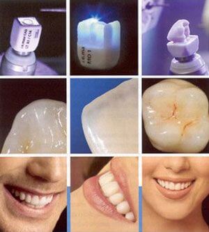 CEREC tooth restoration 