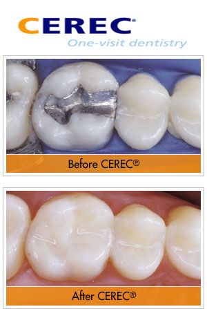 Cerec one-visit dentistry : teeth Before and After Cerec cosmetic treatment