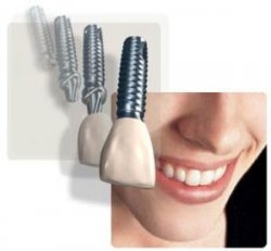 Crabapple Dental Implants
