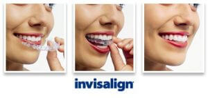 Invisalign in Casuarina NT  Benefits of Invisible Braces