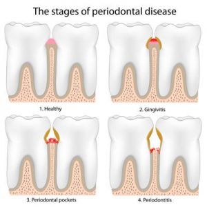 The stages of periodontal disease