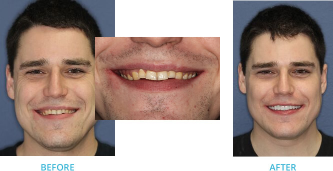 Example of a Full Mouth Reconstruction utilizing a K7 for bite management