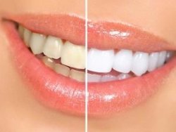 teeth before and after whitening