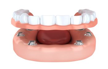 Dental Implants All-on-4 Alpharetta GA