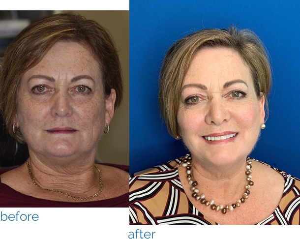 Non Surgical Face Lift Before And After