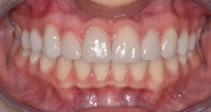 teeth after whitening