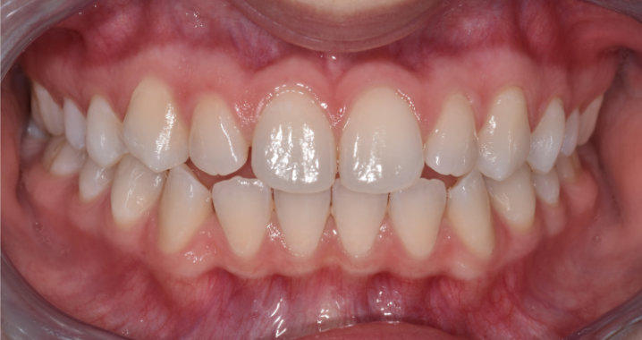 teeth before whitening