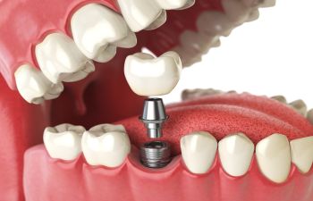 Dental Implants Alpharetta, GA