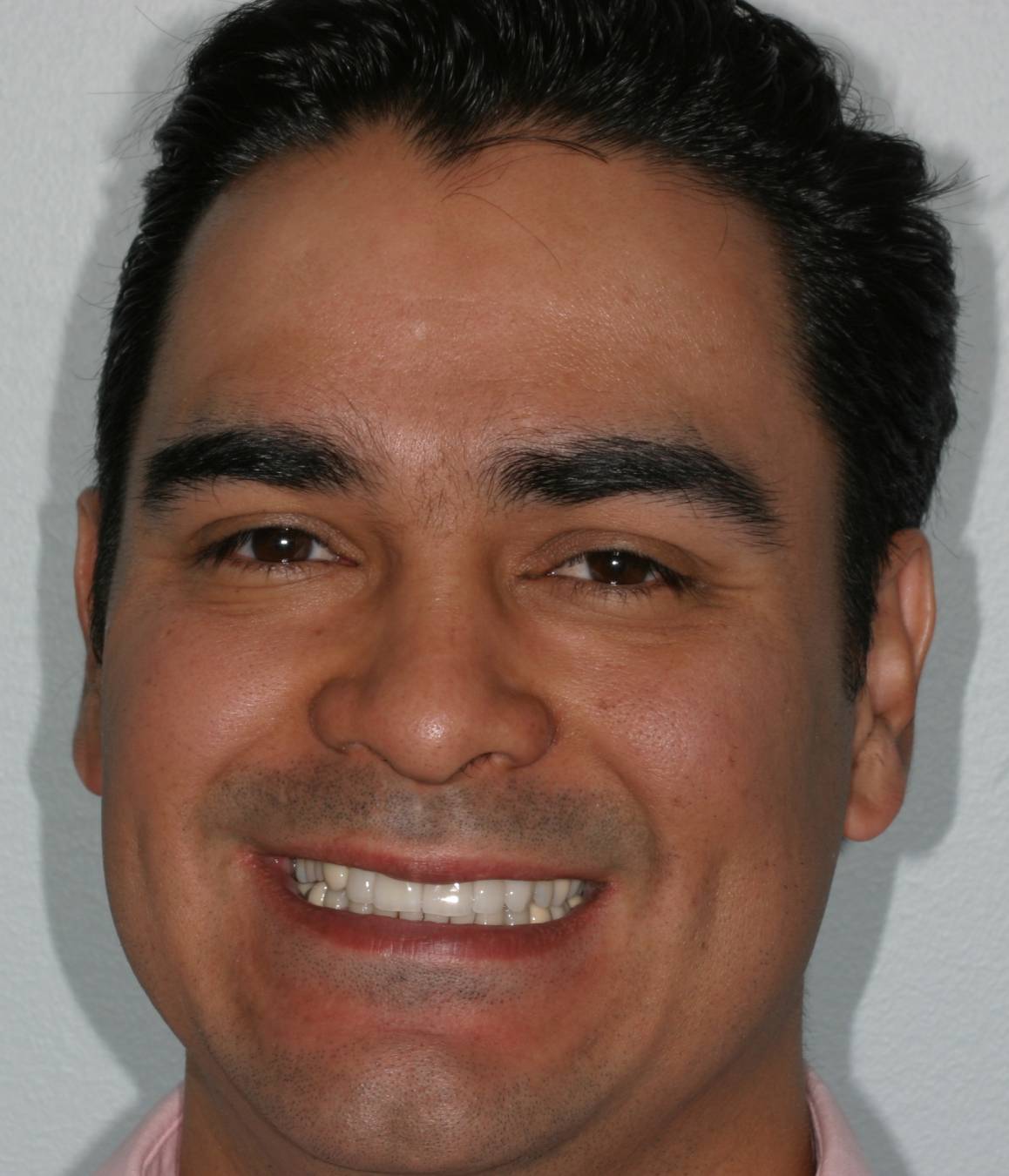 A man with white equal teeth after reconstruction